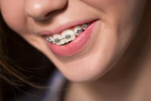 Výhody a nevýhody fixných zubných aparátov